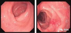 萎縮性胃炎不可怕，只要