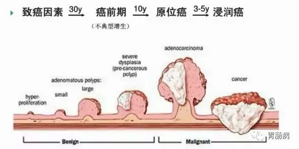 體檢查出腸息肉一定要切除！ 95%腸癌由它演變而來