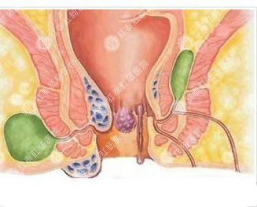 南寧哪個(gè)醫(yī)院可以做肛周膿腫？